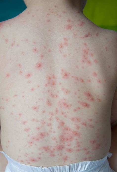 Chickenpox Description Cause And Symptoms Britannica