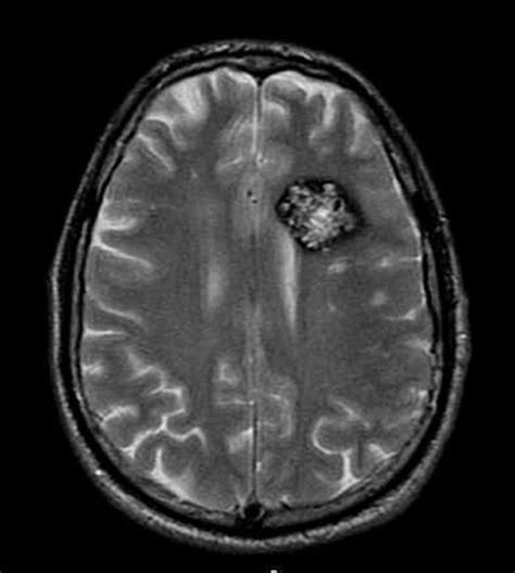 Cavernous Hemangioma Brain