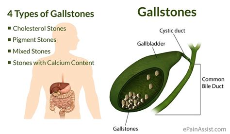Gall Bladder Stones Symptoms Treatments And Causes Reddircom
