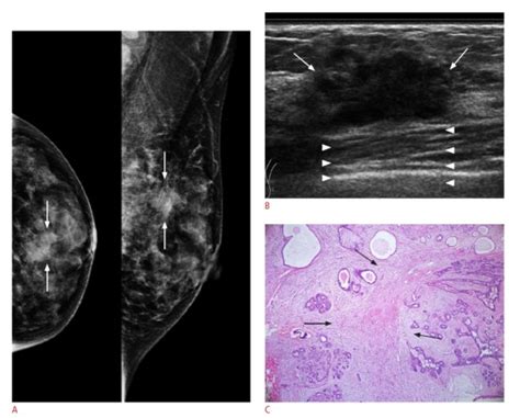 A A Mammogram Shows An Irregular Spiculated Isodense Mass Arrows
