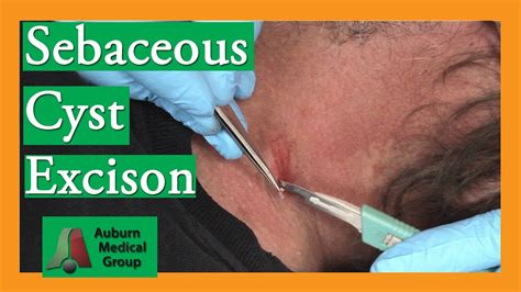 Sebaceous Cyst Removal Auburn Medical Group Youtube