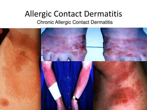 Ppt Contact Dermatitis Powerpoint Presentation Free Download Id