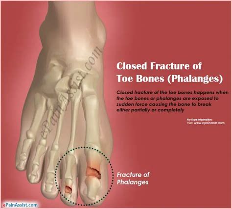 Closed Fracture Of Toe Bones Phalangestreatmentcausessymptoms