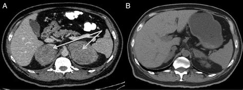 Bilateral Primary Adrenal Lymphoma With Adrenal Insufficiency Bmj