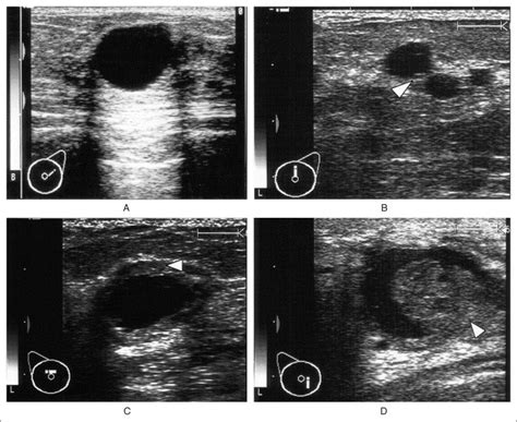 Outcomes Of Sonography Based Management Of Breast Cysts The American