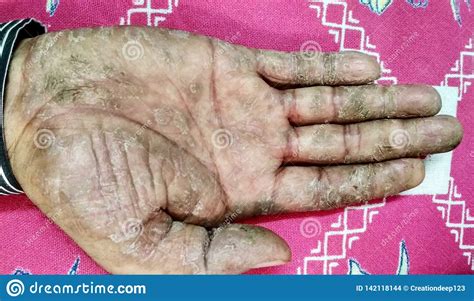 Psoriasis Disease On The Man S Hand Stock Photo Image Of Psoriasis