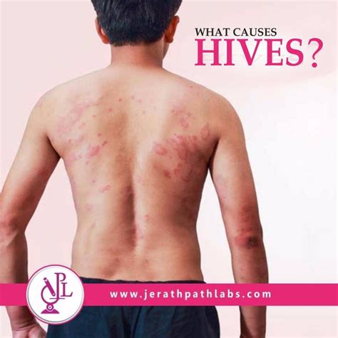 An Allergic Reaction Can Trigger Hives Things That Commonly Trigger An