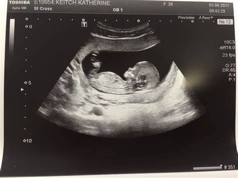 13 Week Baby Scan Pictures Guess The Gender Can I See Your Photos At