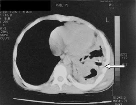 A Chest Ct Scan Demonstrating Loculated Collections And Atelectasis At