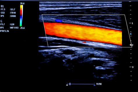 Vascular Ultrasound Imaging Echowavesllc