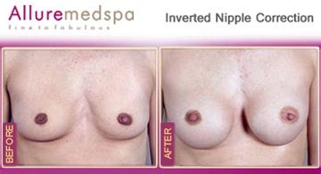Inverted Nipple Correction Surgery Allure Med Spa