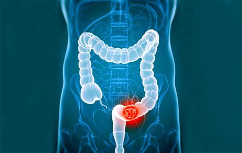 23 Signs And Symptoms Of Colorectal Cancer