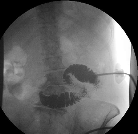 Direct Percutaneous Endoscopic Jejunostomy Tube Placement Using Double
