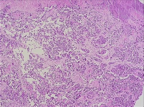 Wd Net Grade 3 Nen32 Showing Nests Of Tumour Cells Underlying A