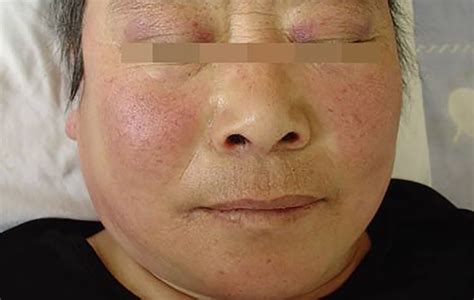 60岁大妈满脸起红色皮疹，最终查出皮肌炎