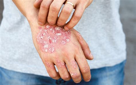 Safely Remove Psoriasis Scales Advanced Dermatology Care