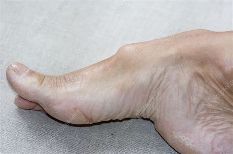 High Arched Foot Stock Image C0027464 Science Photo Library