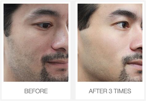 Laser Skin Resurfacing Pores