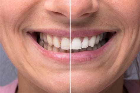 This Is How To Get Really White Teeth