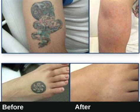Los Angeles Tattoo Removal Laser Tattoo Removal In Los Angeles