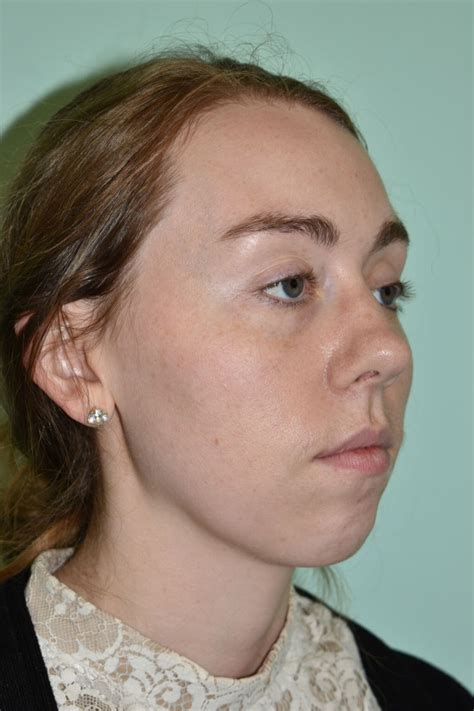 Chin Augmentation Davis Facial Plastic Surgery