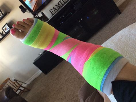 My Rainbow Sherbet Cast Broken Ankle Leg Cast Cast Colors