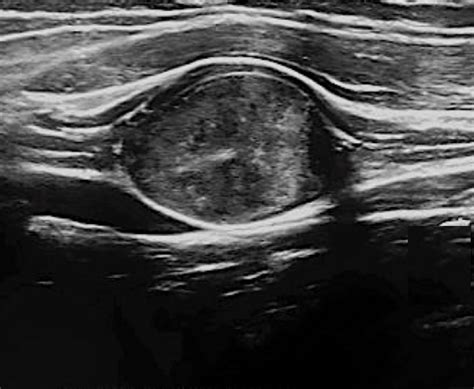 Sonography Of Soft Tissue Palpable Masses