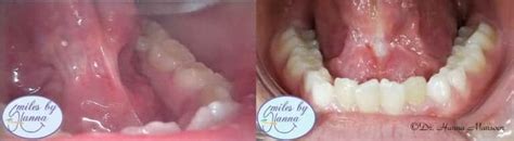 Frenectomy Patient 15 Before And After Smiles By Hanna