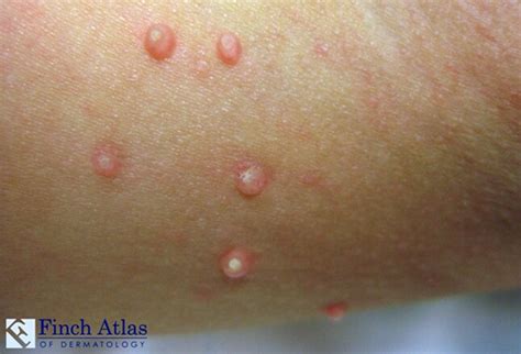 12 Rashes You Need To Know Common Dermatologic Diagnoses