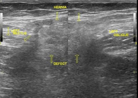 Abdominal Hernia Ultrasound