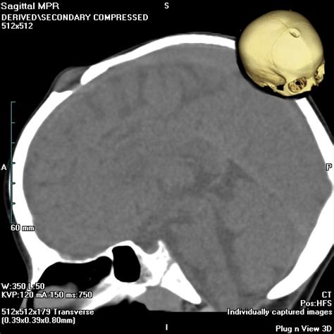 Dermoid Cyst Radrounds Radiology Network