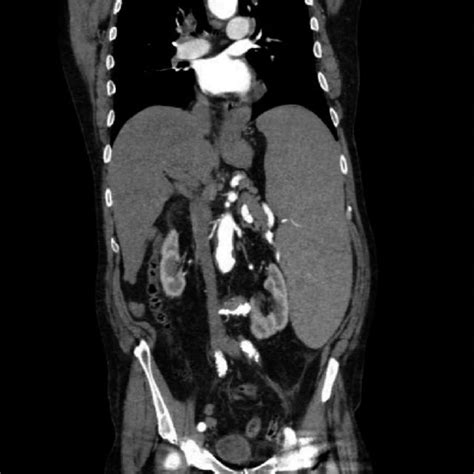 Abdominal Ct Scan Showing A Large Splenic Abscess Occupying The Whole