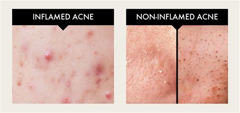 The Ultimate Guide To Adult Acne