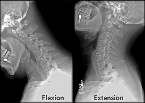How To Treat Cervical Spinal Instability Magbuff