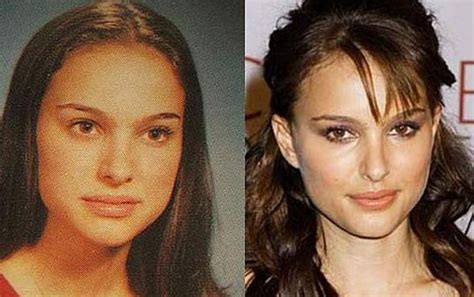 Natalie Portman Nose Job Before And After Deviated Septum Information