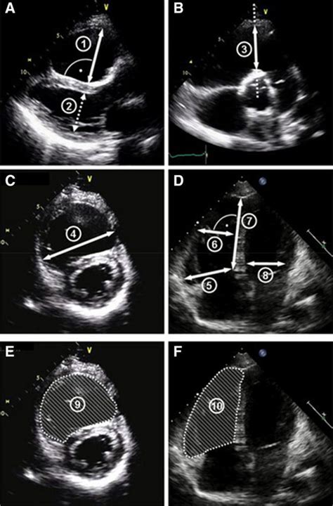 Is Mri The Preferred Method For Evaluating Right Ventricular Size And