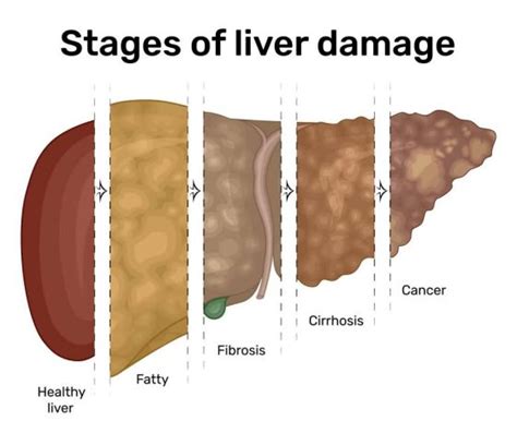 13 Signs Of Liver Damage How To Know If You Have Liver Damage