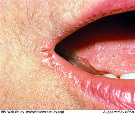 Lip Fungal Infection Dermatology