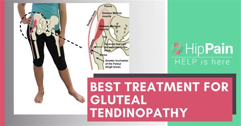 Best Treatment For Gluteal Tendinopathy Trochanteric Bursitis Sexiz Pix