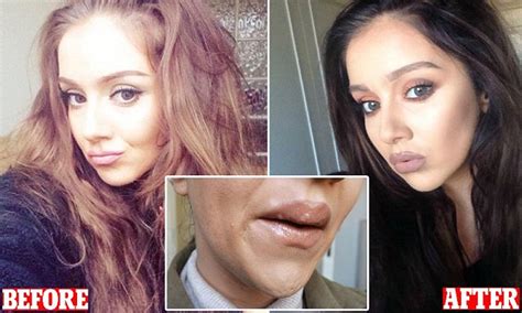Beauty Blogger Laura Meachem Is Left With Lumpy Lips After Botched