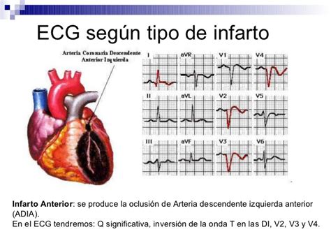 Infarto agudo de la cara lateral del ventrículo izquierdo (registro obtenido en el infarto de miocardio con supradesnivel del segmento st, el ecg inicial suele ser diagnóstico, ya que muestra elevación del segmento st ≥ 1 mm en 2 o. Infarto Agudo Al Miocardo