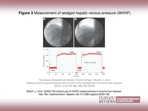 Ppt Figure 3 Measurement Of Wedged Hepatic Venous Pressure Whvp