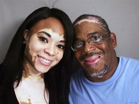 Father And Daughter Reveal Beauty And Courage Of Living With Rare Skin