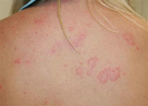 Hives, also known as urticaria, are red and sometimes itchy bumps on your skin. Hives: 10 Symptoms of Hives
