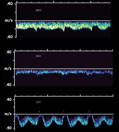 Understanding The Spectral Doppler Waveform Of The Hepatic Veins In