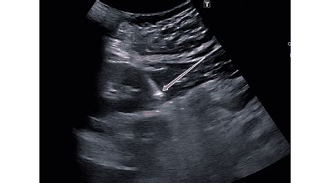 Cureus Safety And Adequacy Of Ultrasound Guided Percutaneous Renal