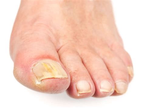Toenail Fungus Remedies Reported Cures Treatments And