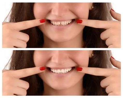 Your Cosmetic Dentist In Fort Lauderdale Has The Solution To Gaps Between Your Teeth Excellence