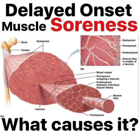 Great Post From My Dude Strengthcoachtherapy 🤓🙏🏼 Why Do I Get Sore⁉️ Delayed Onset Muscle