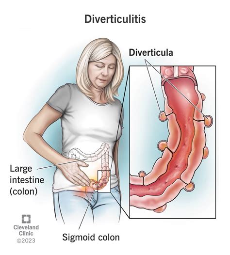 Diverticulitis Symptoms Causes Treatment